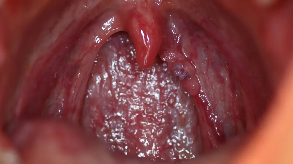 Throat Warts HPV slide 2